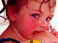 Продукты, часто вызывающие аллергию